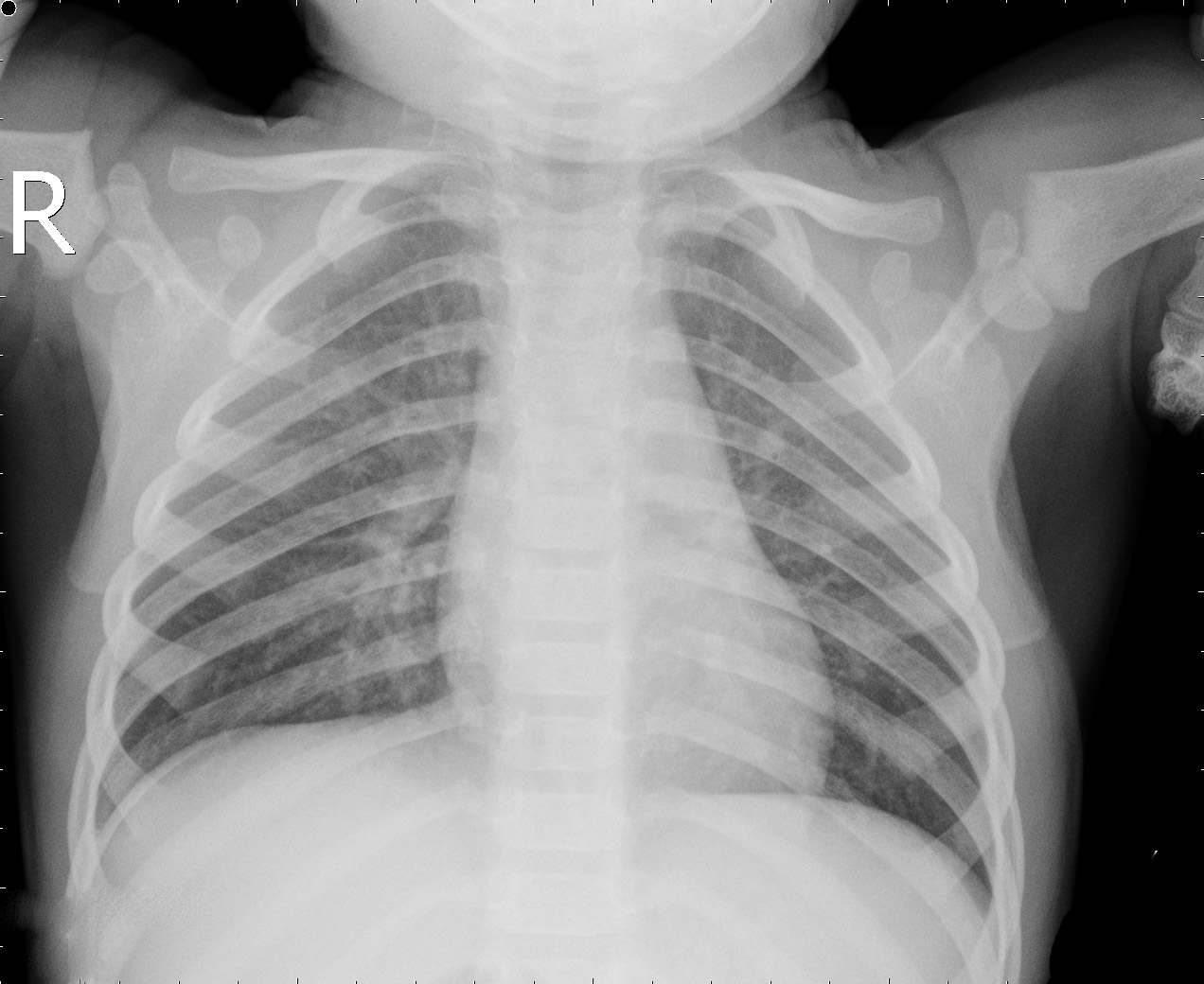 Normal X-ray Example 1