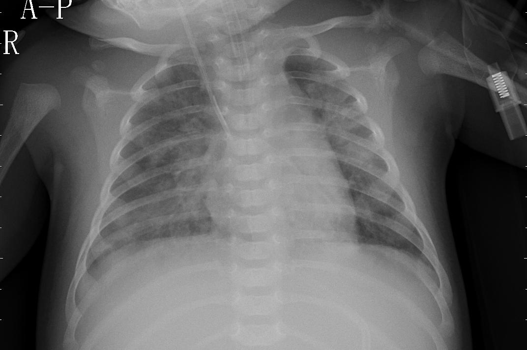 Pneumonia X-ray Example 1